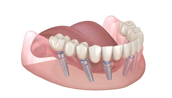 Имплантация All-on-6 за 1 день